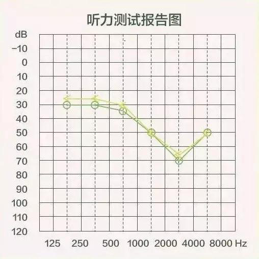右耳听力图