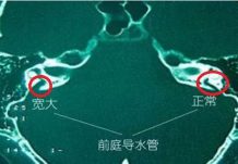 大前庭导水管综合征