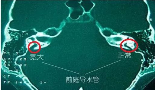 大前庭导水管综合征